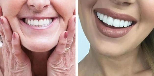 🌟 Carillas Dentales 3D: Tu Nueva Sonrisa en Segundos 😍
