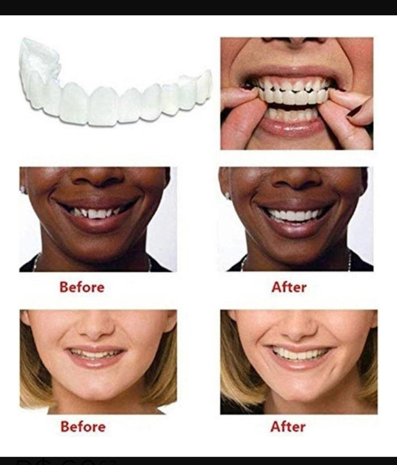 Carillas Dentales Snapon Smile